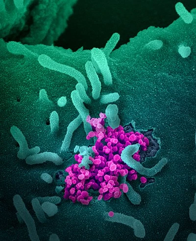 تب، اسهال و شدید بودن بیماری، با سطح بالای آنتی‌بادی پایدار علیه SARS-CoV-2 در ارتباط است